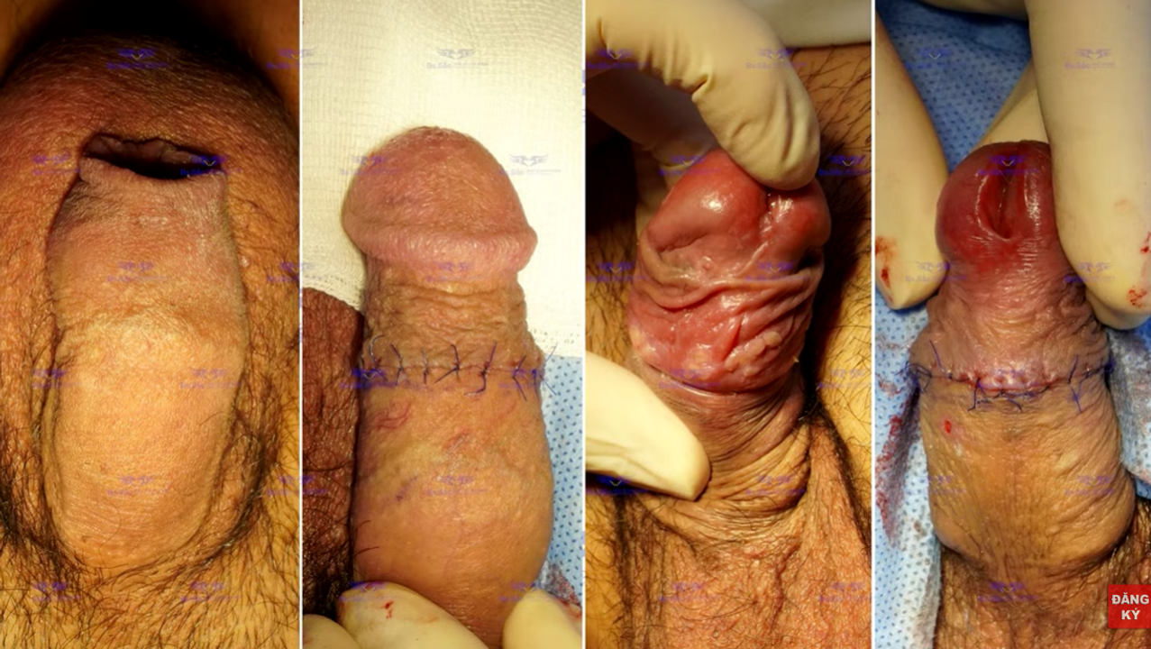 Vết cắt bao quy đầu được khâu tay (Cắt từ video cắt bao quy đầu của Bs Thiều Sĩ Sắc)