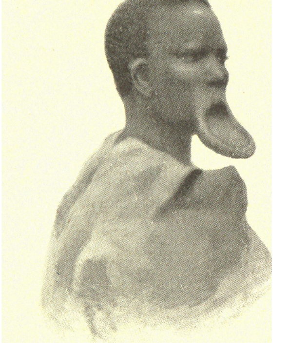 Người bản địa vùng hồ Rudoph bị chinh phục (với đĩa môi đặc trưng)