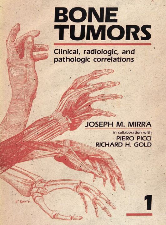 Bone Tumors