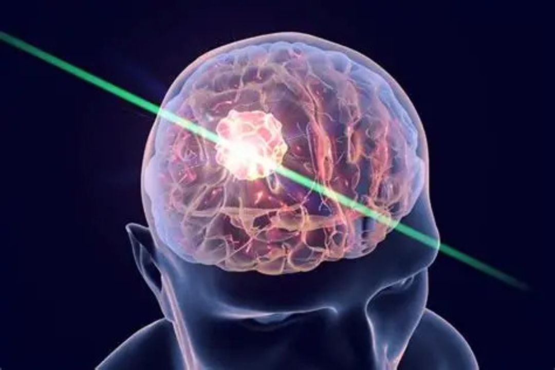 Laser trong phẫu thuật não