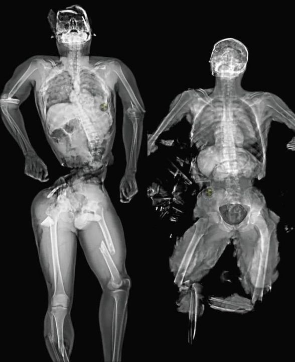 Chụp Mri nạn nhân