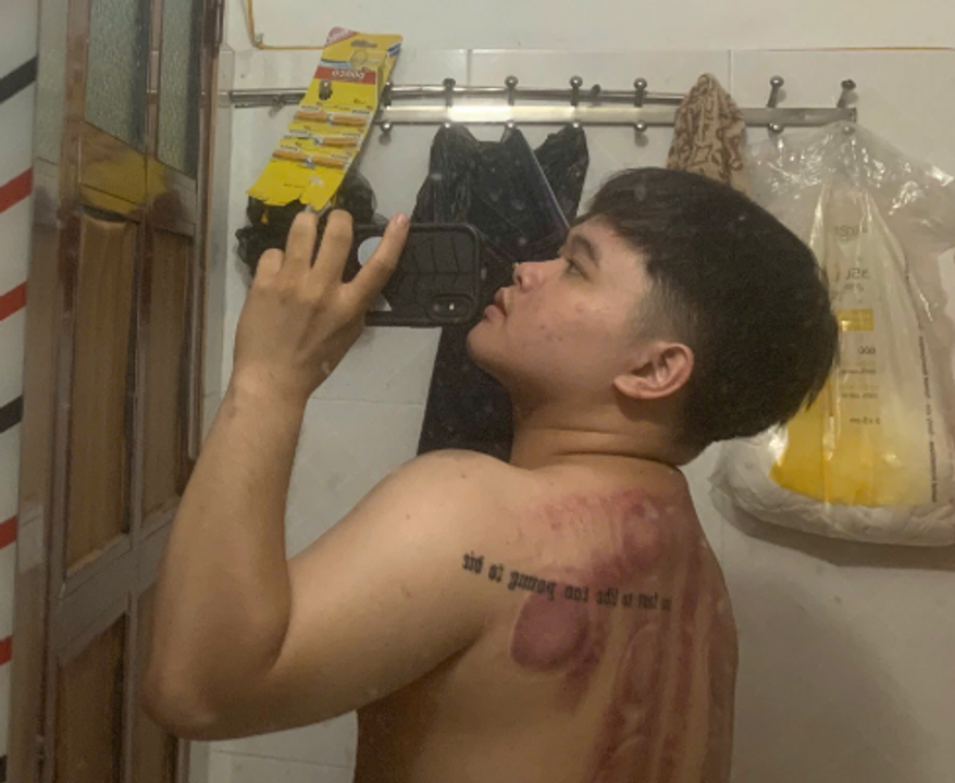 Lưng tôi sau khi nạo gió.