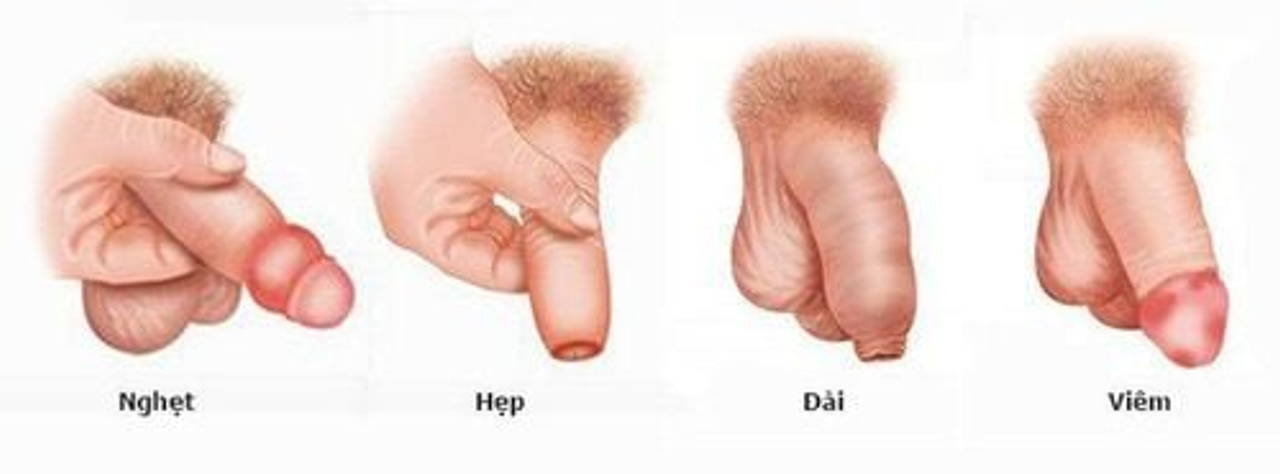 Nghẹt (Tuột được khi cương nhưng bị nghẹt đau khi thủ dâm hoặc quan hệ. Hẹp: không tuột được bao quy đầu. Dài thừa dư bao quy đầu, tuột xuống không nghẹt đau nhưng cơ bản nó bị dài khó vệ sinh