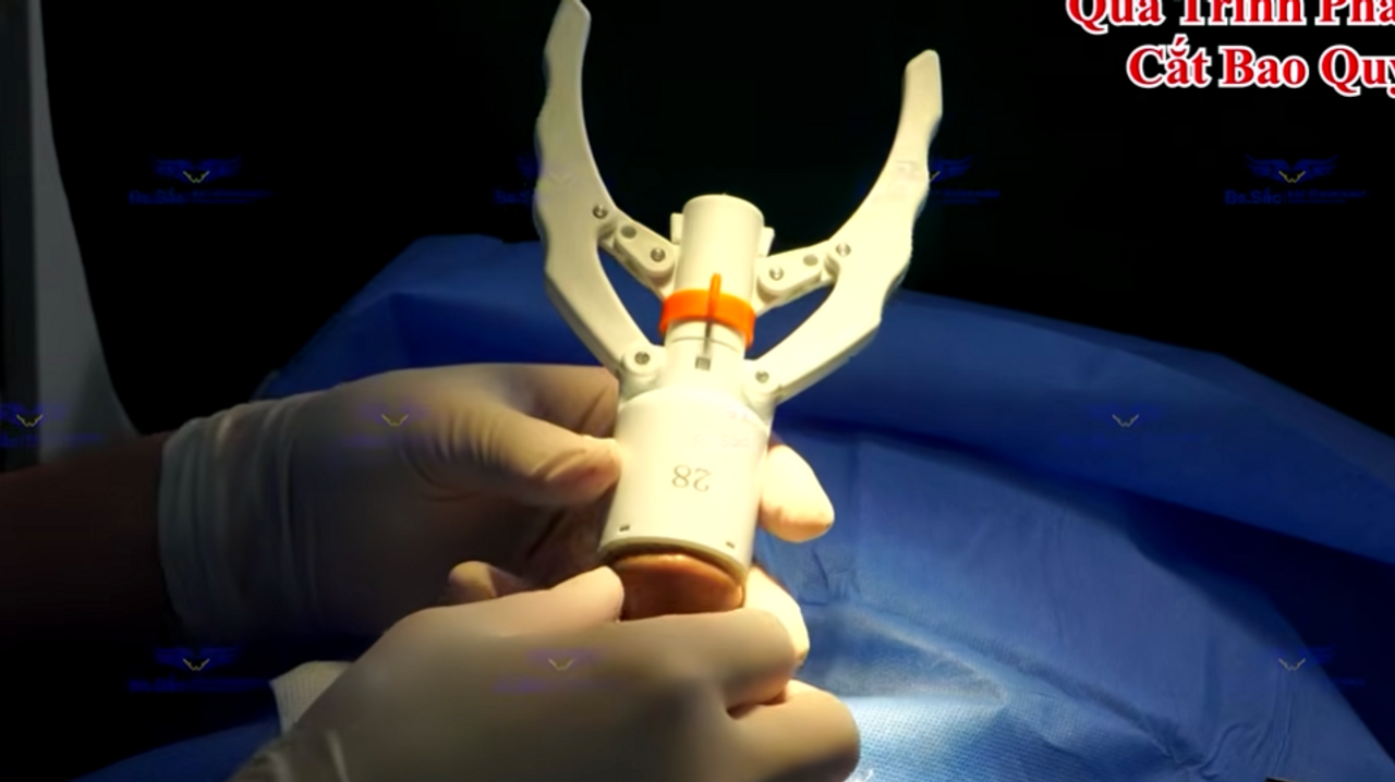 Cắt bằng máy Stapler (Cắt từ video cắt bao quy đầu của Bs Thiều Sĩ Sắc)